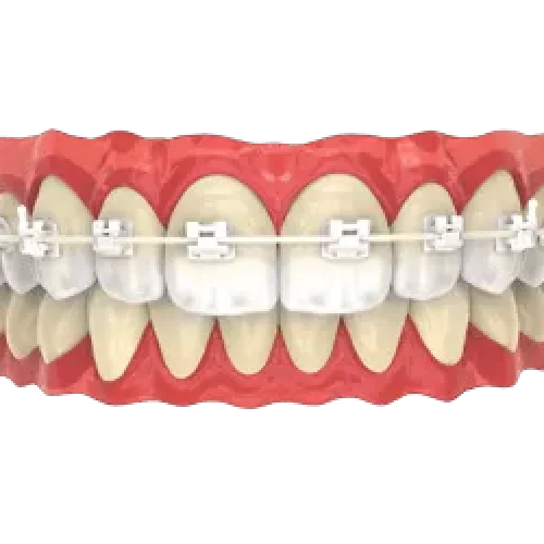 Ceramic-Braces Ceramic-Braces