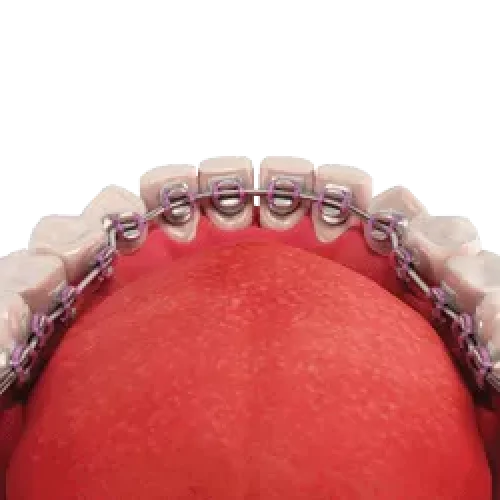 Incognito-Lingual-Braces Incognito-Lingual-Braces