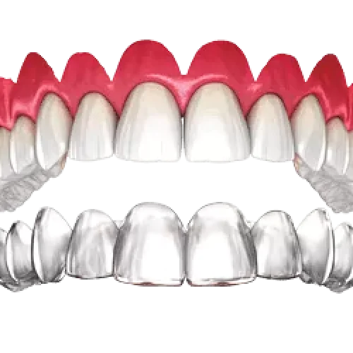 Invisalign-1 Invisalign-1