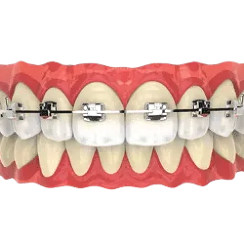 Metal-Braces Metal-Braces