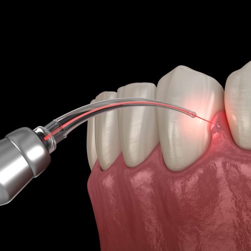 Gum correction surgery with laser.  Medically accurate tooth 3D illustration