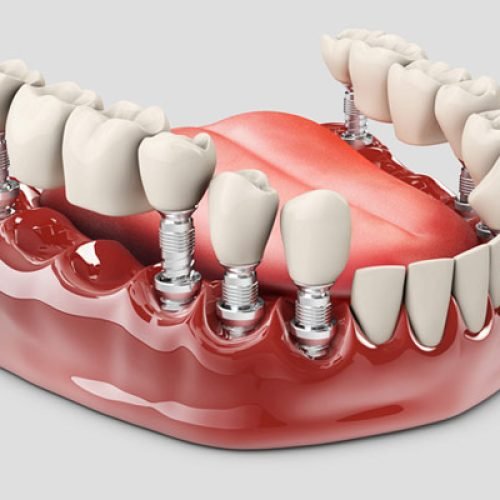 difference-between-crown-and-bridge-procedures
