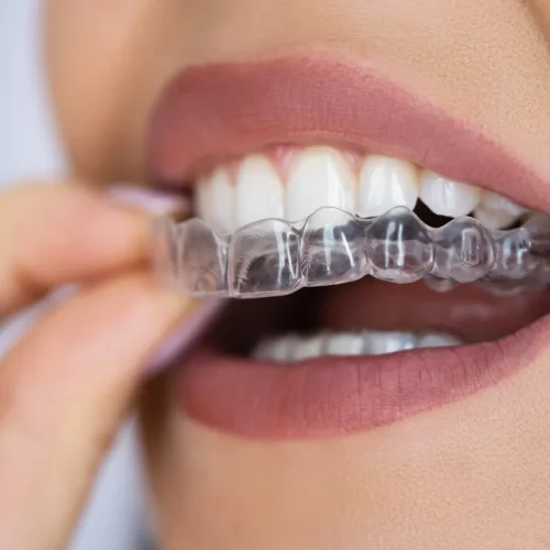 invisalign-appointments-1.webp